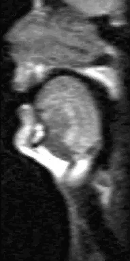MRI scan of tongue during Eee vowel shape